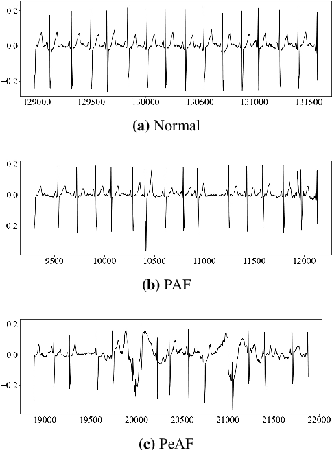 Figure 1 for A Deep Learning Method for Beat-Level Risk Analysis and Interpretation of Atrial Fibrillation Patients during Sinus Rhythm