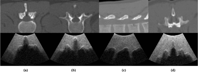Figure 1 for Enabling Augmented Segmentation and Registration in Ultrasound-Guided Spinal Surgery via Realistic Ultrasound Synthesis from Diagnostic CT Volume