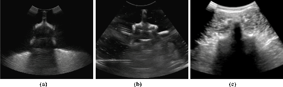 Figure 2 for Enabling Augmented Segmentation and Registration in Ultrasound-Guided Spinal Surgery via Realistic Ultrasound Synthesis from Diagnostic CT Volume