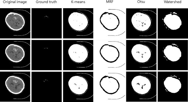 Figure 4 for PHE-SICH-CT-IDS: A Benchmark CT Image Dataset for Evaluation Semantic Segmentation, Object Detection and Radiomic Feature Extraction of Perihematomal Edema in Spontaneous Intracerebral Hemorrhage