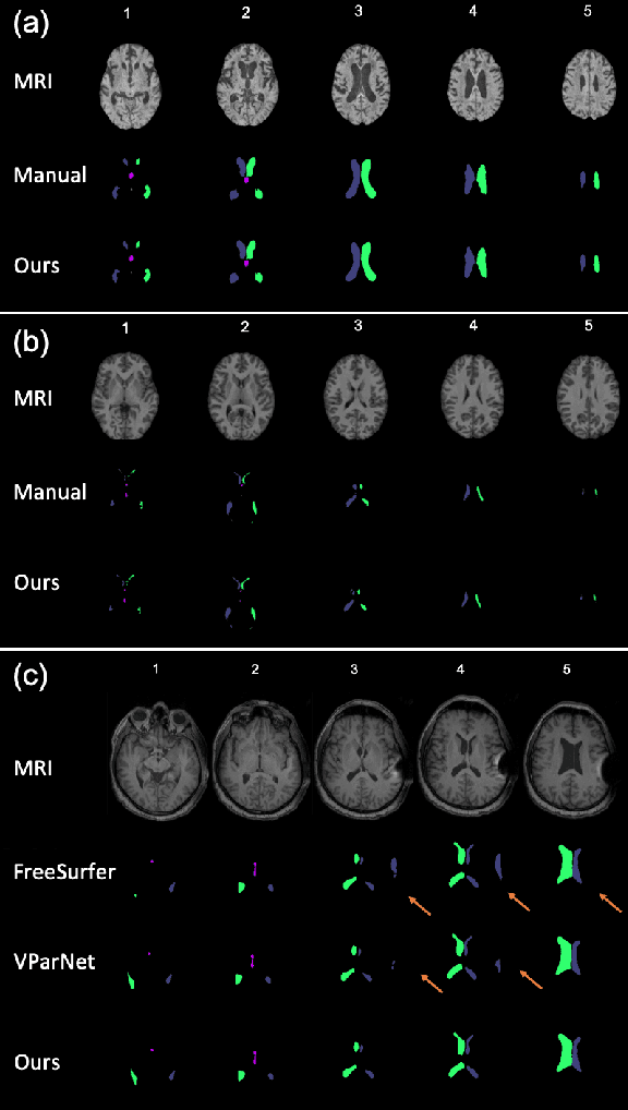 Figure 4 for Automated Ventricle Parcellation and Evan's Ratio Computation in Pre- and Post-Surgical Ventriculomegaly