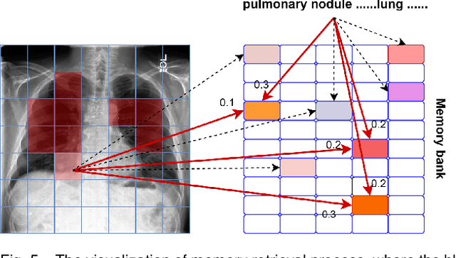 Figure 4 for Memory-based Cross-modal Semantic Alignment Network for Radiology Report Generation