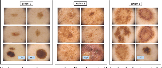 Figure 1 for Ugly Ducklings or Swans: A Tiered Quadruplet Network with Patient-Specific Mining for Improved Skin Lesion Classification