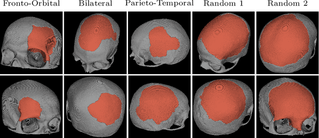 Figure 3 for Point Cloud Diffusion Models for Automatic Implant Generation
