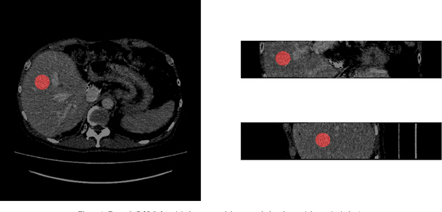Figure 1 for A Comprehensive Study of Radiomics-based Machine Learning for Fibrosis Detection