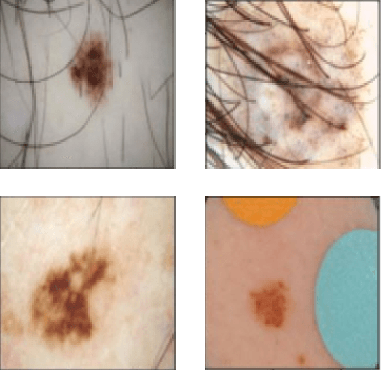 Figure 1 for U-Net-based Models for Skin Lesion Segmentation: More Attention and Augmentation
