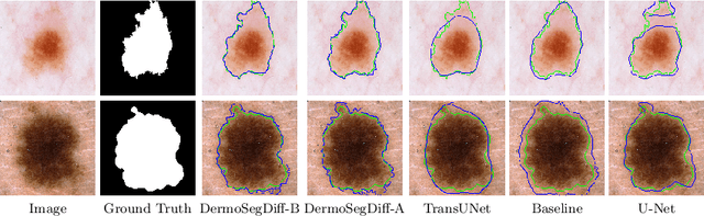Figure 4 for DermoSegDiff: A Boundary-aware Segmentation Diffusion Model for Skin Lesion Delineation