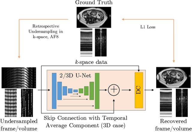 Figure 3 for The Challenge of Fetal Cardiac MRI Reconstruction Using Deep Learning