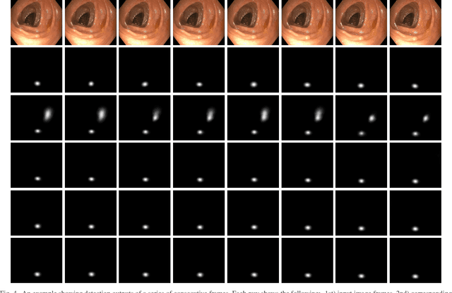 Figure 4 for Accurate Real-time Polyp Detection in Videos from Concatenation of Latent Features Extracted from Consecutive Frames