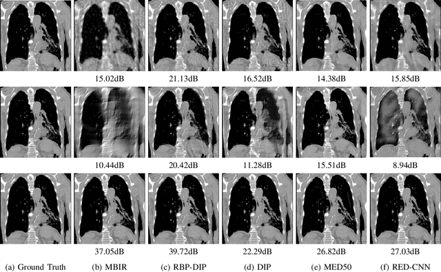 Figure 3 for RBP-DIP: High-Quality CT Reconstruction Using an Untrained Neural Network with Residual Back Projection and Deep Image Prior