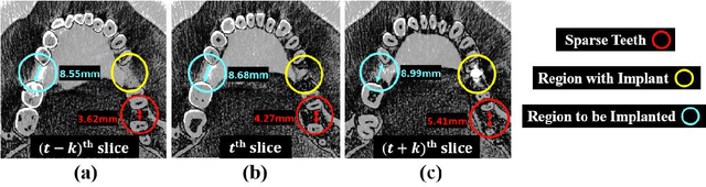 Figure 1 for TCSloT: Text Guided 3D Context and Slope Aware Triple Network for Dental Implant Position Prediction