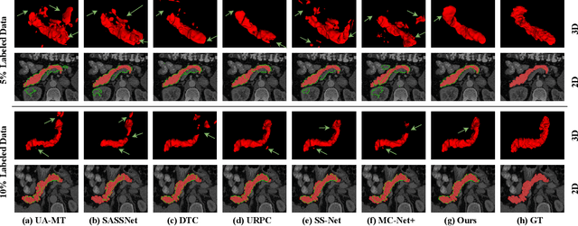 Figure 4 for Dual-Decoder Consistency via Pseudo-Labels Guided Data Augmentation for Semi-Supervised Medical Image Segmentation
