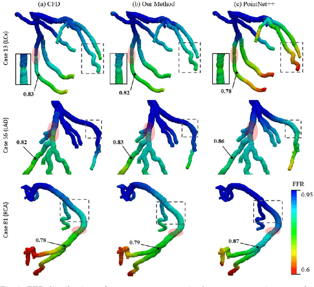 Figure 4 for Voxel2Hemodynamics: An End-to-end Deep Learning Method for Predicting Coronary Artery Hemodynamics