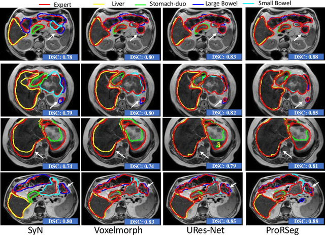 Figure 2 for Progressively refined deep joint registration segmentation (ProRSeg) of gastrointestinal organs at risk: Application to MRI and cone-beam CT