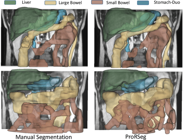 Figure 4 for Progressively refined deep joint registration segmentation (ProRSeg) of gastrointestinal organs at risk: Application to MRI and cone-beam CT