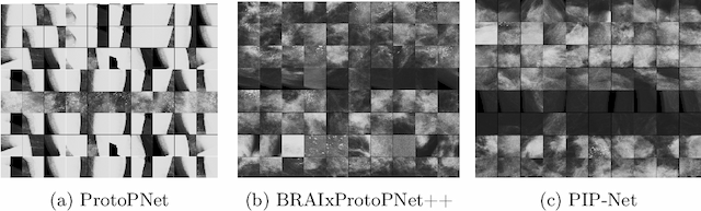 Figure 4 for Prototype-based Interpretable Breast Cancer Prediction Models: Analysis and Challenges