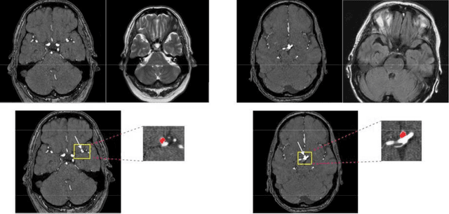 Figure 2 for nnDetection for Intracranial Aneurysms Detection and Localization
