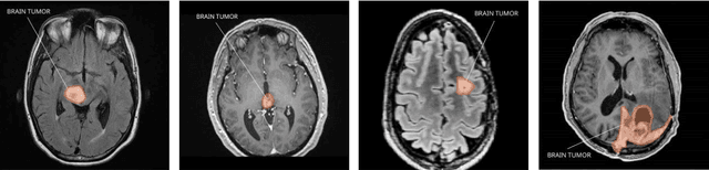 Figure 4 for A deep learning approach for brain tumor detection using magnetic resonance imaging