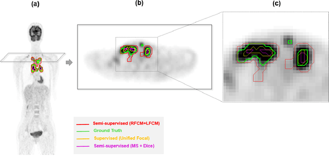 Figure 3 for Semi-supervised learning towards automated segmentation of PET images with limited annotations: Application to lymphoma patients