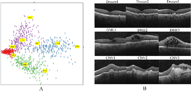 Figure 4 for Active Globally Explainable Learning for Medical Images via Class Association Embedding and Cyclic Adversarial Generation