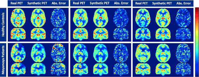 Figure 4 for Brain MRI-to-PET Synthesis using 3D Convolutional Attention Networks