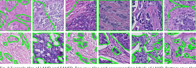 Figure 3 for Experts' cognition-driven safe noisy labels learning for precise segmentation of residual tumor in breast cancer