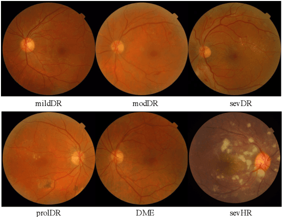 Figure 3 for A Foundation LAnguage-Image model of the Retina (FLAIR): Encoding expert knowledge in text supervision