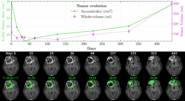 Figure 1 for Treatment-aware Diffusion Probabilistic Model for Longitudinal MRI Generation and Diffuse Glioma Growth Prediction
