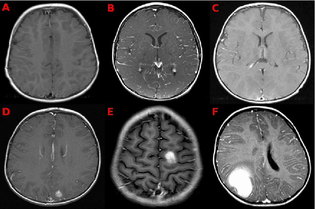 Figure 2 for Deep neuroevolution for limited, heterogeneous data: proof-of-concept application to Neuroblastoma brain metastasis using a small virtual pooled image collection