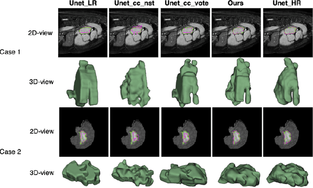 Figure 4 for SuperMask: Generating High-resolution object masks from multi-view, unaligned low-resolution MRIs
