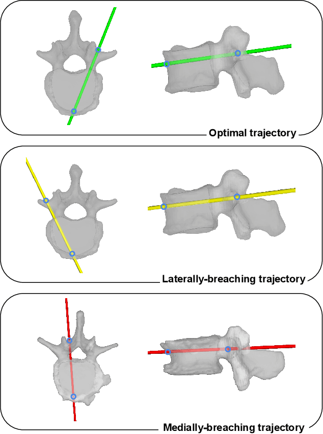 Figure 2 for Automatic breach detection during spine pedicle drilling based on vibroacoustic sensing