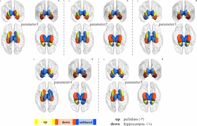 Figure 4 for Identification of Causal Relationship between Amyloid-beta Accumulation and Alzheimer's Disease Progression via Counterfactual Inference