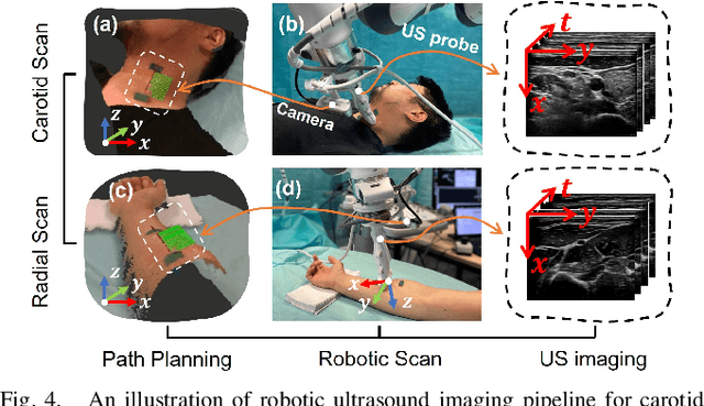 Figure 4 for Motion Magnification in Robotic Sonography: Enabling Pulsation-Aware Artery Segmentation