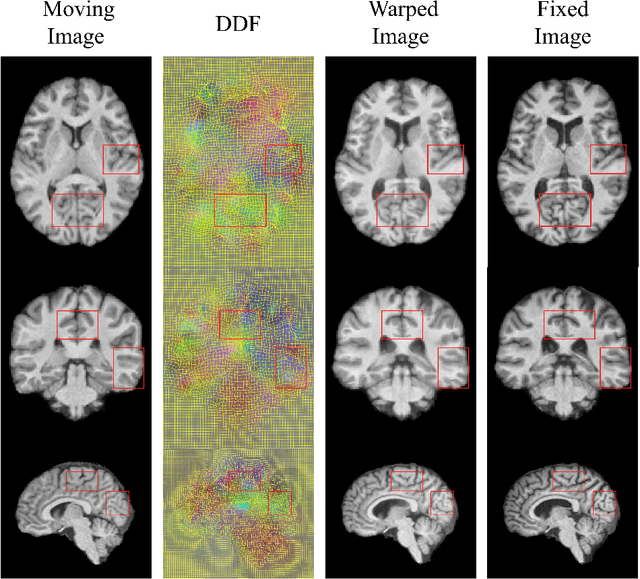 Figure 1 for Deformable Image Registration with Multi-scale Feature Fusion from Shared Encoder, Auxiliary and Pyramid Decoders