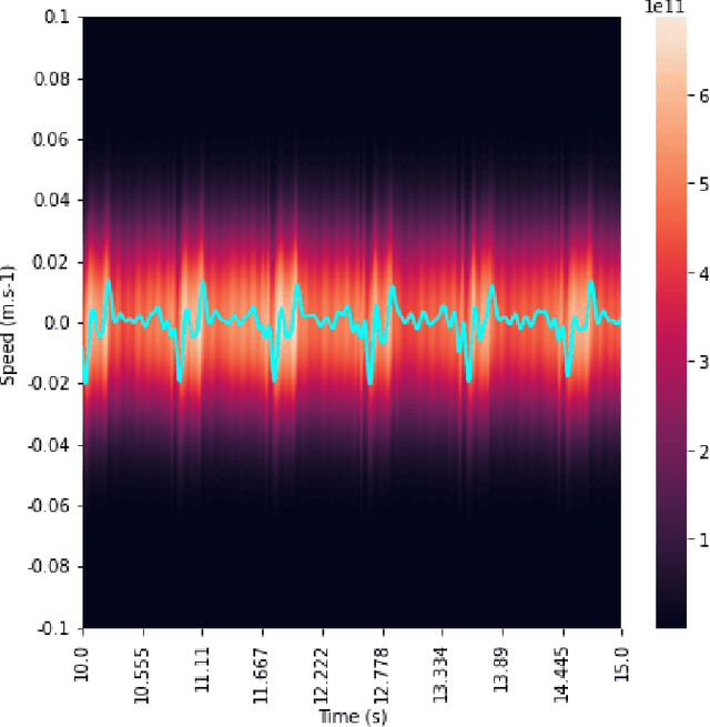 Figure 3 for Monitoring of the heart movements using a FMCW radar and correlation with an ECG