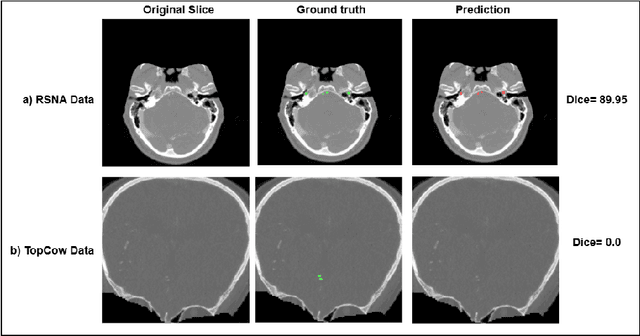 Figure 1 for XAI-Driven Diagnosis of Generalization Failure in State-Space Cerebrovascular Segmentation Models: A Case Study on Domain Shift Between RSNA and TopCoW Datasets