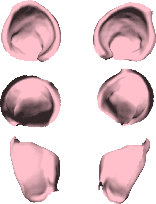 Figure 3 for Gaussian Process Diffeomorphic Statistical Shape Modelling Outperforms Angle-Based Methods for Assessment of Hip Dysplasia