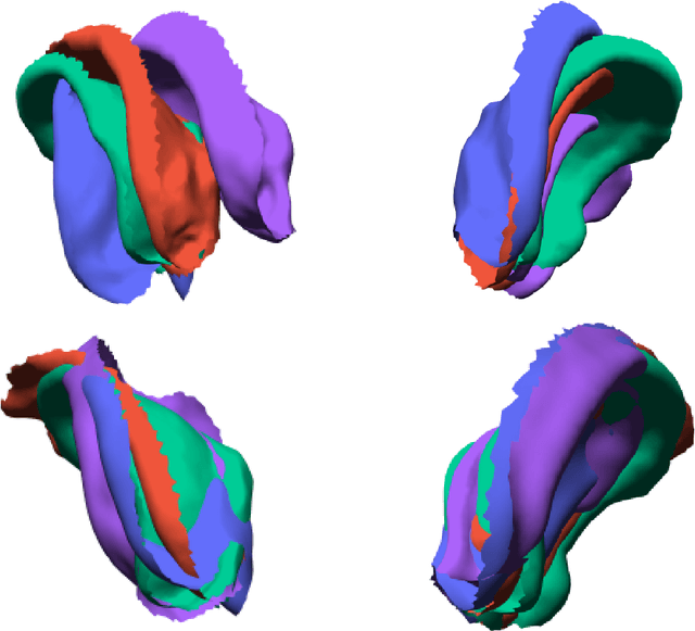 Figure 4 for Gaussian Process Diffeomorphic Statistical Shape Modelling Outperforms Angle-Based Methods for Assessment of Hip Dysplasia