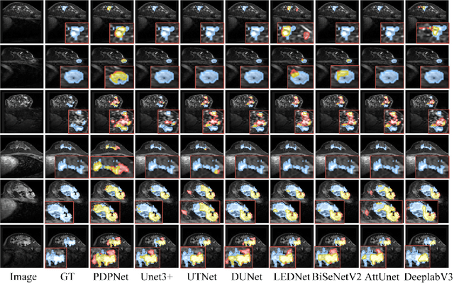 Figure 4 for Progressive Dual Priori Network for Generalized Breast Tumor Segmentation