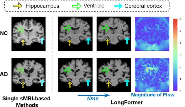 Figure 1 for Longformer: Longitudinal Transformer for Alzheimer's Disease Classification with Structural MRIs