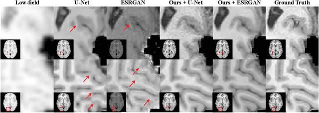 Figure 3 for Tackling Hallucination from Conditional Models for Medical Image Reconstruction with DynamicDPS
