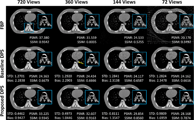 Figure 2 for Strategies for CT Reconstruction using Diffusion Posterior Sampling with a Nonlinear Model