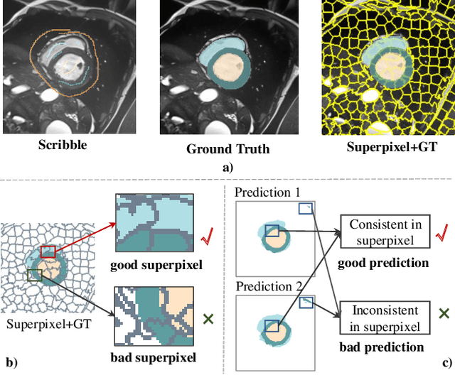 Figure 1 for SP${ }^3$ : Superpixel-propagated pseudo-label learning for weakly semi-supervised medical image segmentation