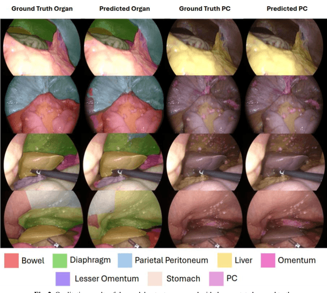 Figure 4 for Artificial Intelligence for the Assessment of Peritoneal Carcinosis during Diagnostic Laparoscopy for Advanced Ovarian Cancer