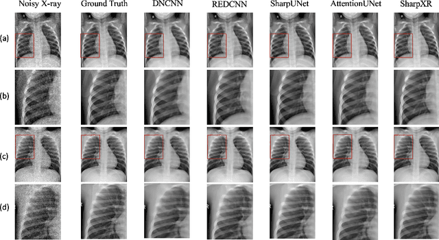 Figure 4 for SharpXR: Structure-Aware Denoising for Pediatric Chest X-Rays