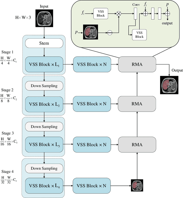 Figure 1 for A Reverse Mamba Attention Network for Pathological Liver Segmentation