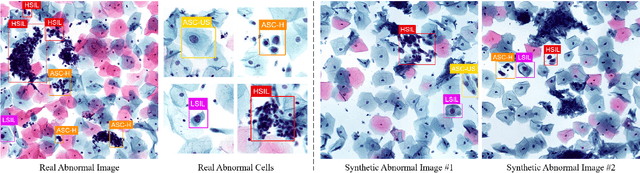 Figure 1 for Two-stage Cytopathological Image Synthesis for Augmenting Cervical Abnormality Screening