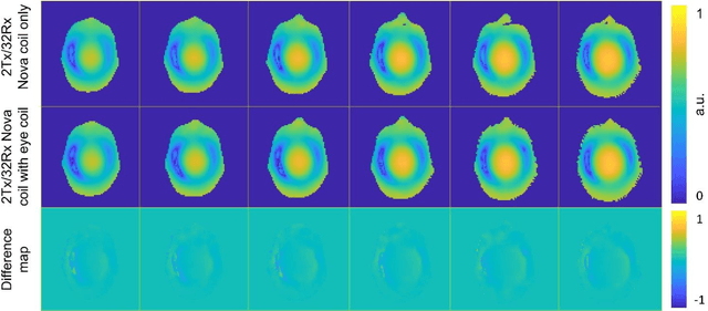 Figure 3 for Low-Cost and Detunable Wireless Resonator Glasses for Enhanced Eye MRI with Concurrent High-Quality Whole Brain MRI