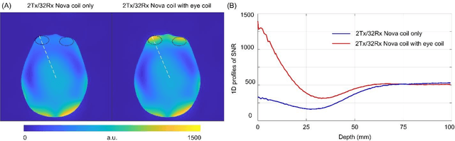Figure 4 for Low-Cost and Detunable Wireless Resonator Glasses for Enhanced Eye MRI with Concurrent High-Quality Whole Brain MRI