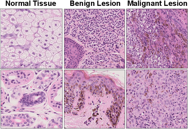 Figure 2 for Detection and Localization of Melanoma Skin Cancer in Histopathological Whole Slide Images
